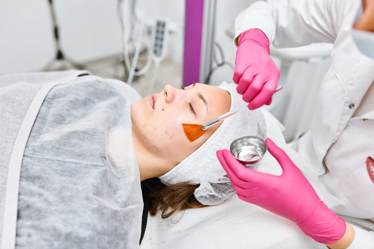 Chemical Peels