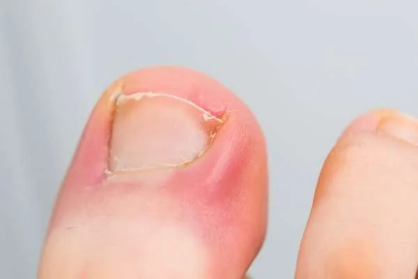 Ingrown Toenail